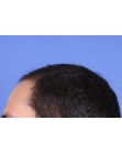 Before Hair Transplant Front